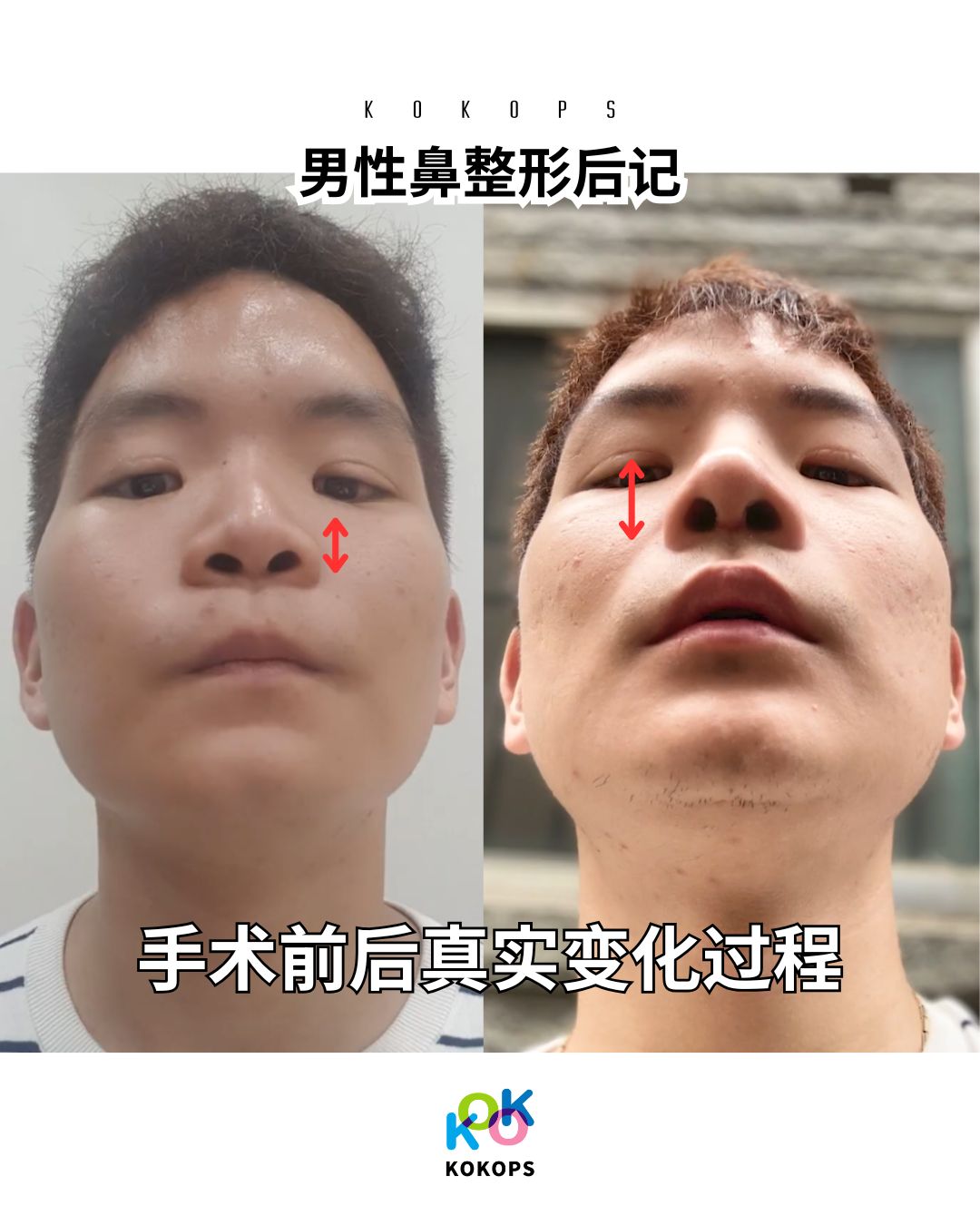 鼻整形名医亲自操刀的男性隆鼻手术前后对比图|改善低鼻梁与朝天鼻的真实变化过程(KOKO整形外科)