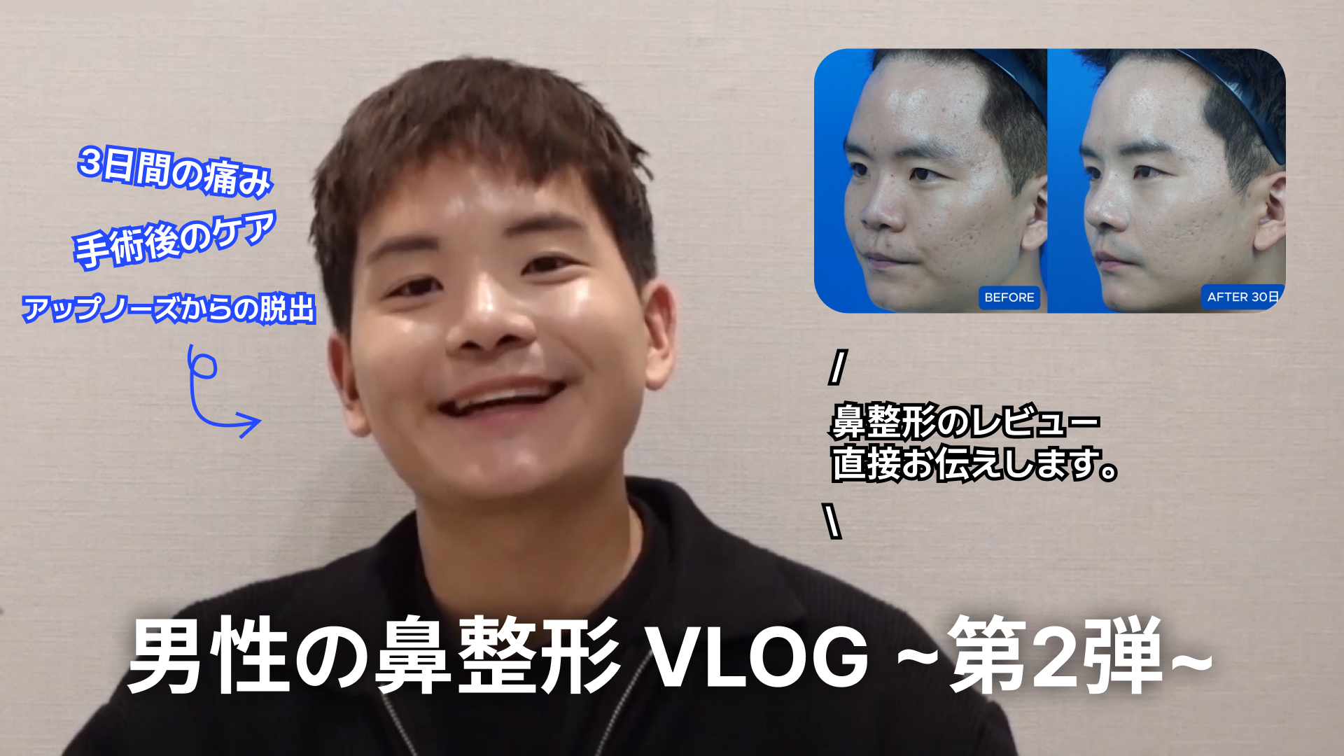 男性の鼻整形VLOG(ビデオブログ)のYouTubeサムネイル画像。 中央: 笑顔で話している若い男性の姿。 右上: 整形前(BEFORE)と30日後(AFTER 30日)の鼻の横顔を比較したビフォーアフター写真。 テキスト内容: 中央下部(大文字): 「男性の鼻整形 VLOG ~第2弾~」 左上(青文字): 「3日間の痛み」「手術後のケア」「アップノーズからの脱出」 中央右側: 「鼻整形のレビュー直接お伝えします。」