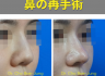 鼻の再手術