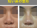 短い鼻の整形